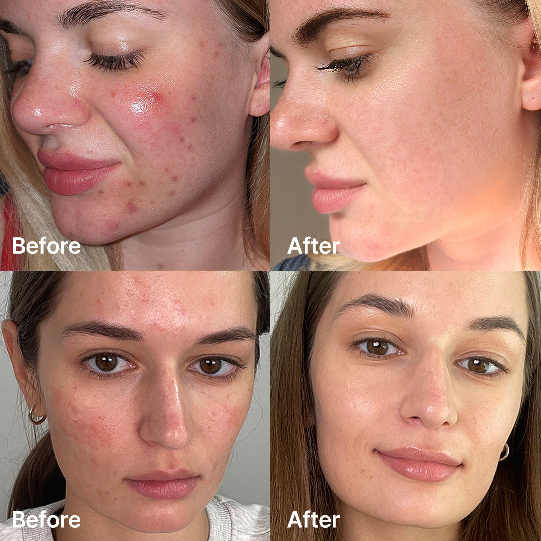 Medicube Red Succinic Acid Clarifying Serum 30ml | Acne & Spot Care